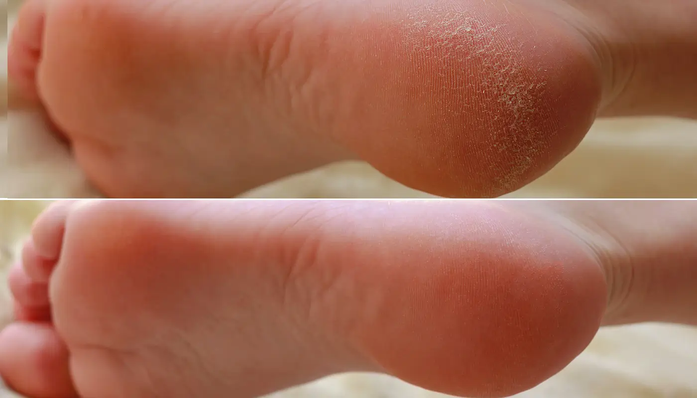 pe-rachado-antes-depois-0720-1400x800-dois.jpg